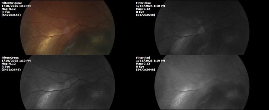 The photograph of the superior temporal region of the retina of the right eye shows the extent of subretinal bleeding as well as retinal edema.