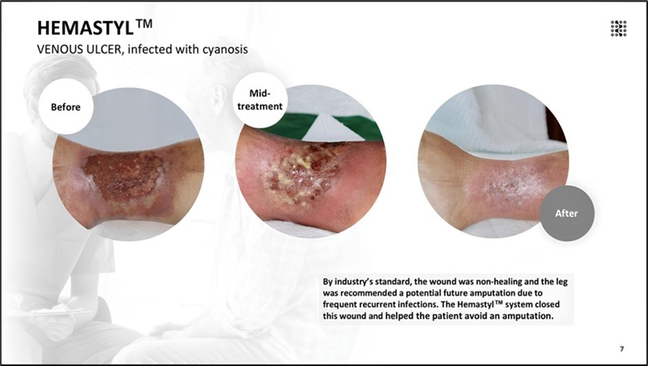 By industry’s standard, the wound was non-healing and the leg was recommended for potential future amputation due to frequent recurrent infections. The Hemastyl™ System closed this wound in 50 days and helped the patient avoid an amputation.
