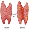 Journal of Thyroid Cancer - Differentiated thyroid cancer